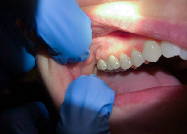 Best Emergency Dentist for Lost Fillings or Crowns in Orchards, WA